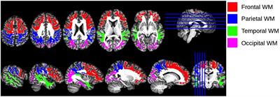 Disparities in Diffuse Cortical White Matter Integrity Between Socioeconomic Groups